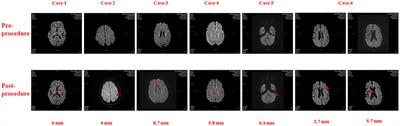 Atrial Fibrillation Ablation Using Robotic Magnetic Navigation Reduces the Incidence of Silent Cerebral Embolism